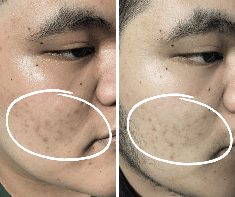 An Individual with acne prone skin was struggling to control oil and post acne pigmentation. He used Croia's 2% Salicylic Acid + Niacinamide Toner for a month and reported less oily face and fewer acne marks without any irritation.